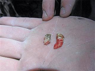 Removing wolf teeth Removing wolf teeth
